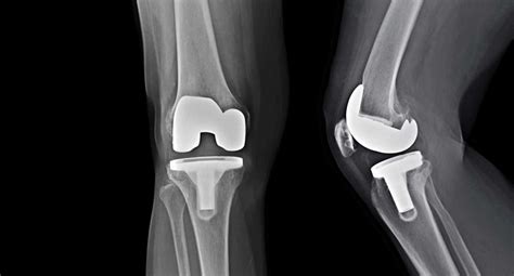 Biomet Knee Implant Recalls