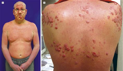 Progression of Undiagnosed Cutaneous T-Cell Lymphoma During Efalizumab ...