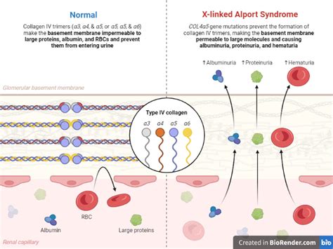 X-linked Alport syndrome (XLAS)- Introduction, Types, Causes, Diagnosis ...