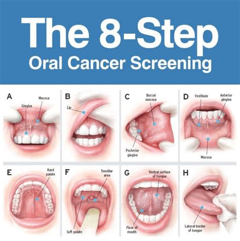 Early Detection Test for Mouth Cancer - Georgian Dental® Barrie