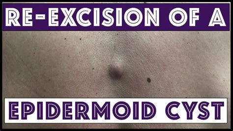 Re-Excision of a Cyst on the Lower Back - YouTube