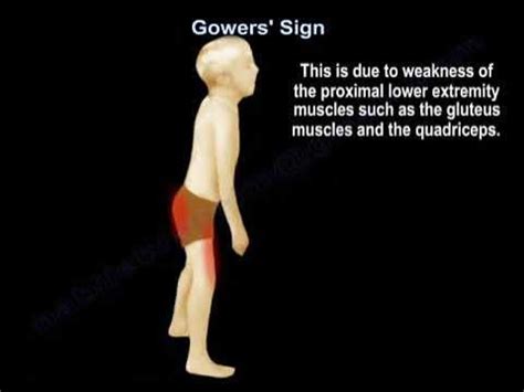 Gower's Sign - YouTube