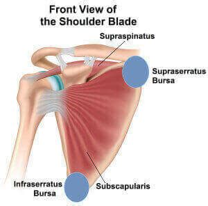 Scapulothoracic Bursitis aka Snapping Scapula Syndrome