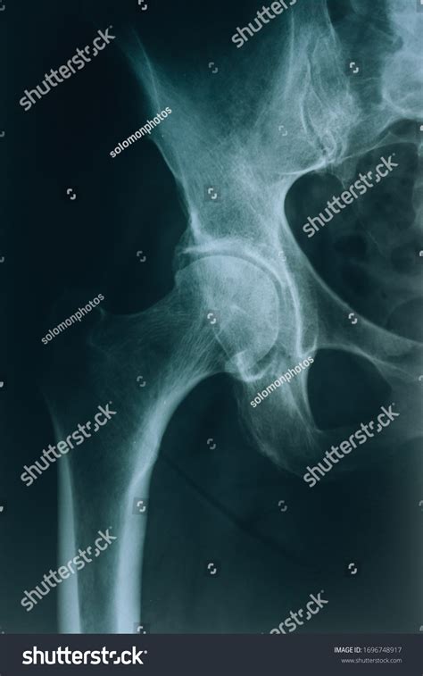 Xray Hip Joint Joint Injury Hip Stock Photo 1696748917 | Shutterstock