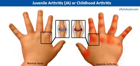 Juvenile Arthritis (JA) or Childhood Arthritis|Symptoms|Treatment ...