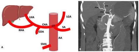 Diagnostics | Free Full-Text | Importance of Anatomical Variation of the Hepatic Artery for ...