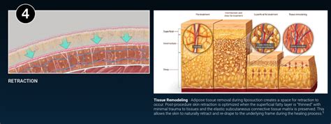 How Much Does VASER Lipo Cost? - Moein Surgical Arts