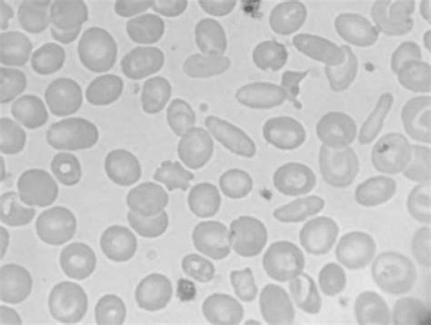 Peripheral blood smear in IDA anemia (microcytosis, poikilocytosis,... | Download Scientific Diagram