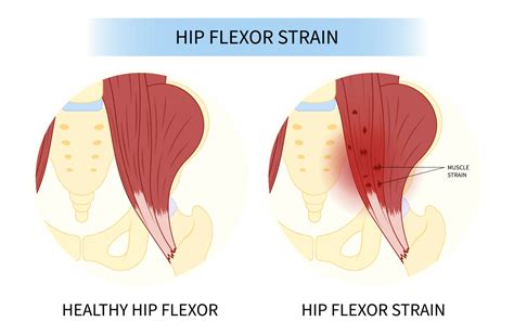 8 Best Hip Flexor Rehab Stretches & Exercises