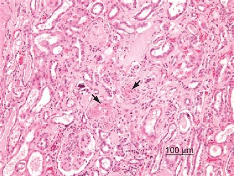 Human nephropathy associated with hypertension. The interlobular... | Download Scientific Diagram