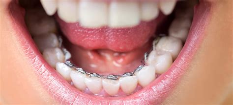 8 preguntas frecuentes sobre la ortodoncia lingual - Clínica Dental Enbata