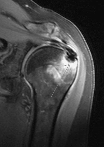 Calcific tendinitis of the rotator cuff associated with intraosseous loculation: Two case ...