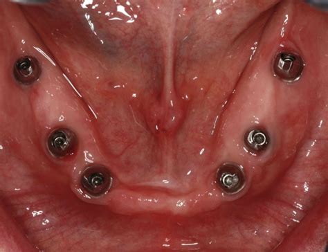 How Many Implants in the Edentulous Mandible? - Spear Education