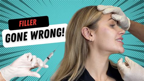 Filler Gone Wrong! Fixing Botched Cheek/Chin Filler - YouTube