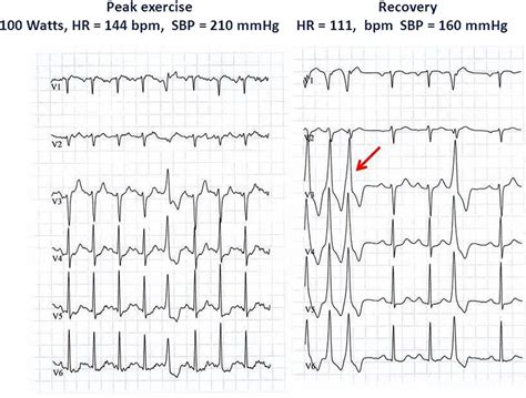 Ventricular ectopy after exercise and occult ischaemia in a patient with multiple risk factors ...