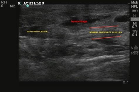 ultrasound of achilles tendon rupture