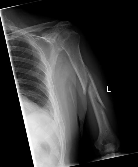 Humeral shaft fracture - wikidoc