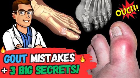 The 🔥Gout MISTAKES & 3 BIG Secrets!🔥 [Symptoms, Diet & Treatment]