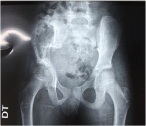 X-ray of the pelvis showing osteolysis of the right iliac wing ...