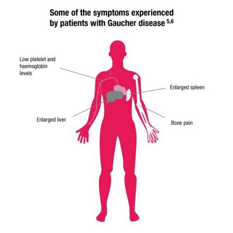 Some of the symptoms | Gaucher's disease, Enlarged liver, Symptoms