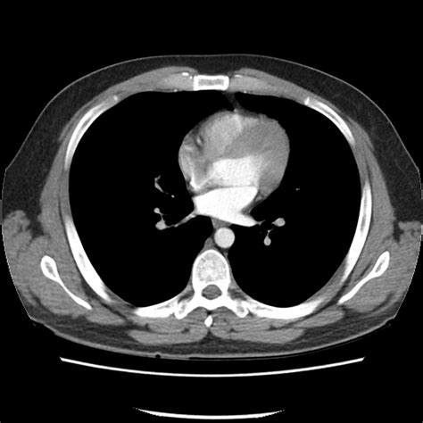 What Is A Ct Scan With Contrast Of The Neck