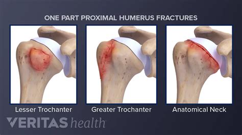 Proximal Humerus Fracture Presentation