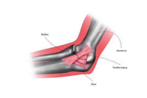 Elbow ligament injuries | Circle Health