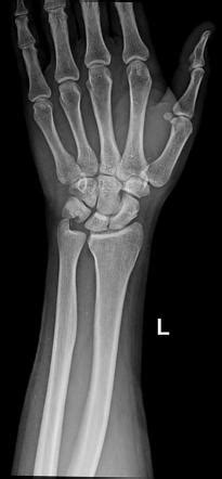 Ulnar Styloid