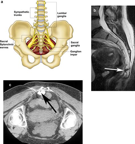 CT-guided injection for ganglion impar blockade: a radiological approach to the management of ...