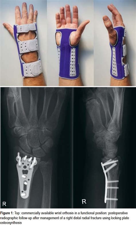 Early Mobilization Versus Splinting After Surgical Management of Distal Radius Fractures (26.06. ...