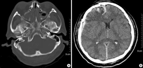 Initial CT scan showing a longitudinal clivus fracture extending from ...