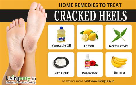 Cracked Heels Remedies Prevention Tips and Care at Home