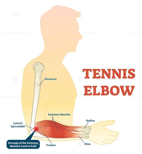 Tennis elbow medical fitness anatomy vector illustration diagram with arm bones, joint and ...