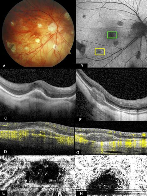 Optical coherence tomography angiography (OCTA) as a new diagnostic ...