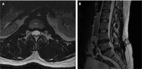 Figure 1 from Spinal subdural hygroma as a post-operative complication in revision spine fusion ...