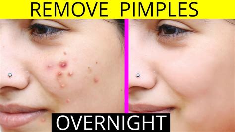 How To Remove Pimples Overnight | Acne Treatment | Anaysa - YouTube