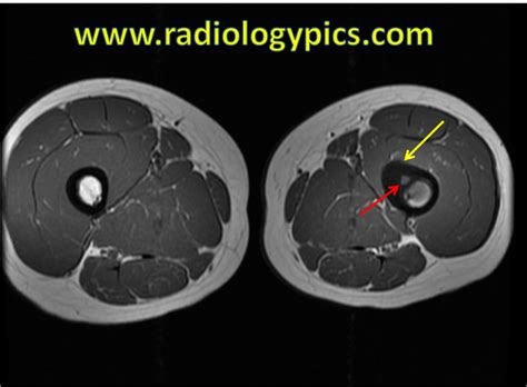 Solution to Unknown Case #36 – Osteoid Osteoma | RADIOLOGYPICS.COM