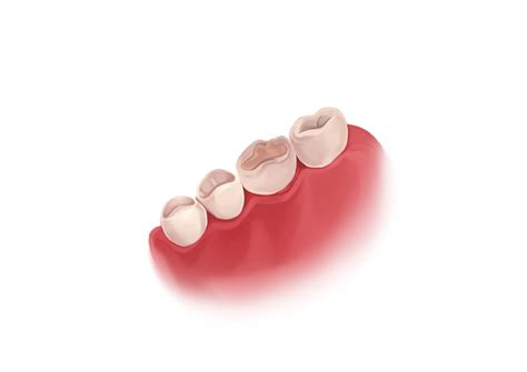 Cavity filling: types and procedure | Authority Dental