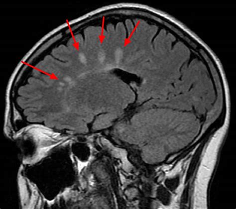 Brain lesions causes, brain lesions diagnosis and brain lesions treatment