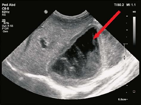 Ultrasound showing right adrenal hematoma (seventh day of life ...