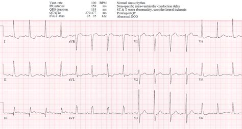 Reciprocal Changes and Occlusion MI | ECG Cases | Emergency Medicine Cases