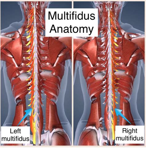 Multifidus And Erector Spinae