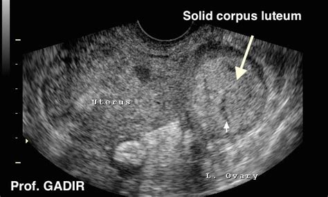 Occasionally a corpus luteum may have a solid texture as shown Ultrasound School, Ultrasound ...