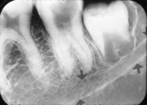 Anatomy Monday: Mandibular Canal – Dr. G's Toothpix