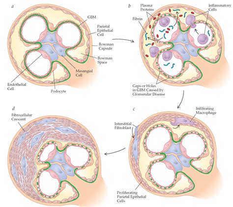 Glomerular Diseases Part 3