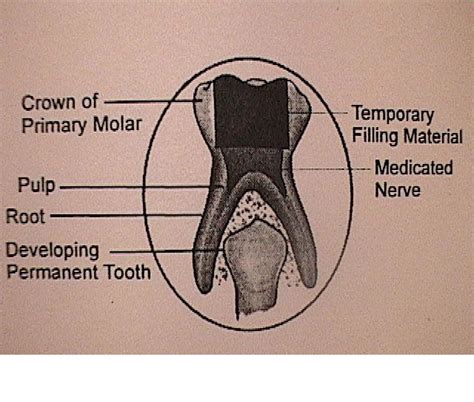 Pulpotomy (Root Canal) of Primary(Baby) Teeth - Kids Smiles Pediatric DentistryKids Smiles ...