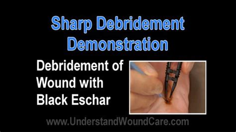 Sharp Debridement | Vohra Wound Physicians