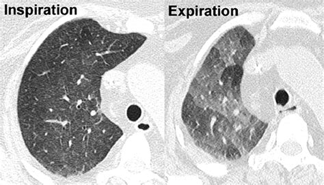 Chest Medicine Made Easy-Dr Deepu: The HRCT findings of Bronchiectasis.