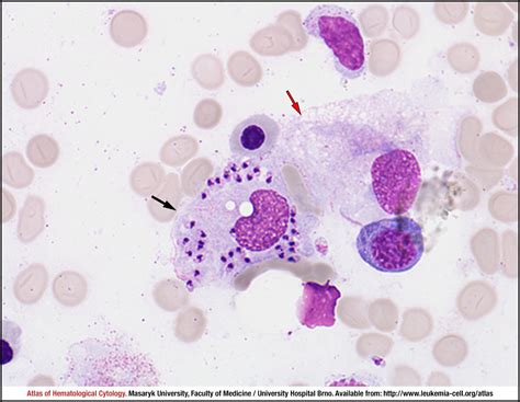 Visceral leishmaniasis - CELL - Atlas of Haematological Cytology