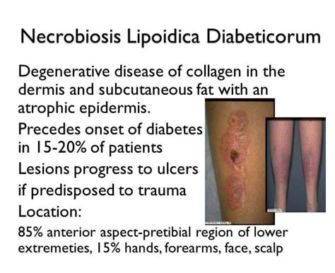 Necrobiosis Lipoidica Diabeticorum